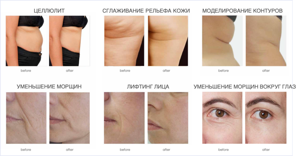 Аппарат виброкомпрессионного роликового массажа Lefis Slimspheres